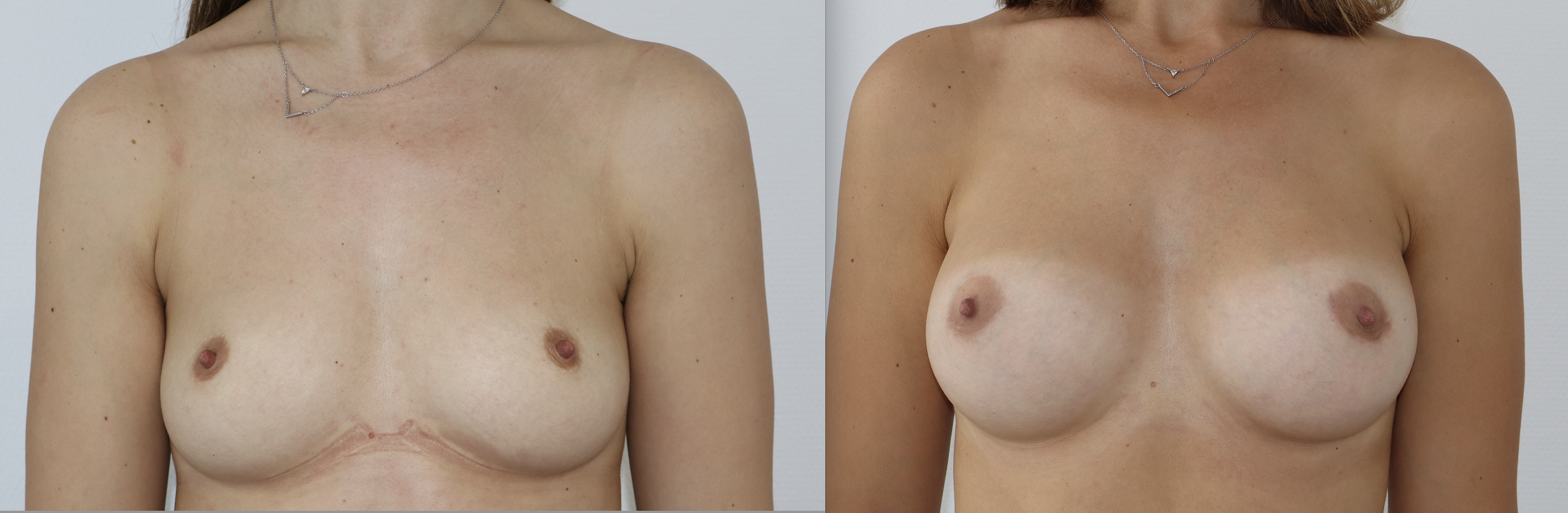 Avant/Après prothèses mammaires